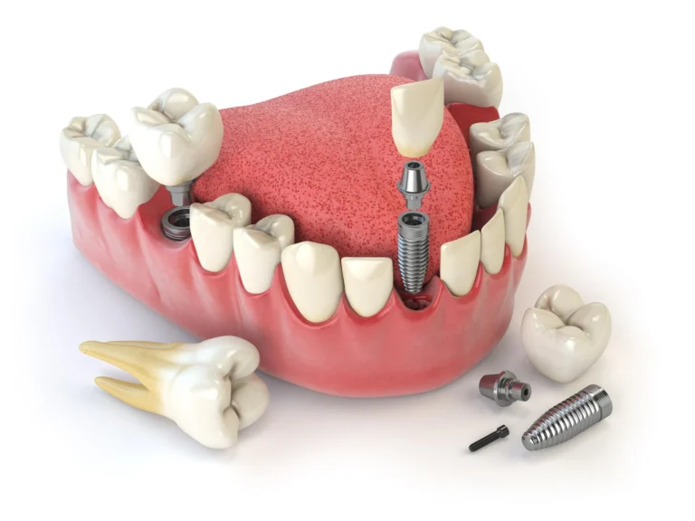 Dental Implants - Mont Albert Dental Surgery