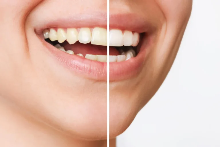 Teeth Whitening - Mont Albert Dental Surgery