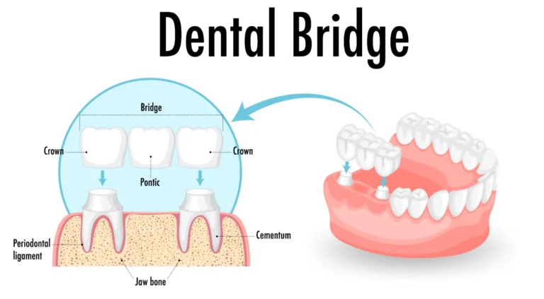 Dental Bridge - Mont Albert Dental Surgery