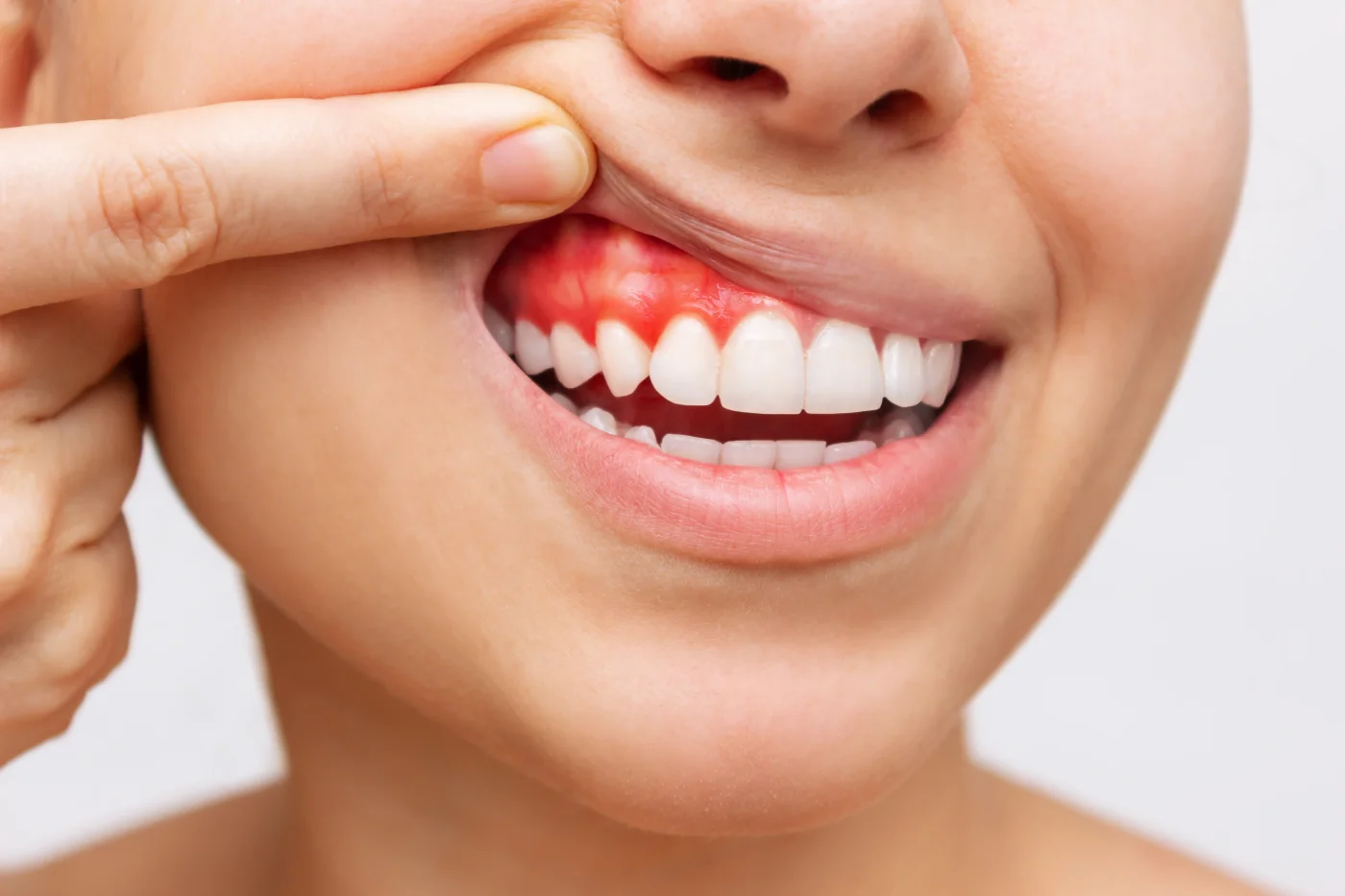Gum Care - Mont Albert Dental Surgery